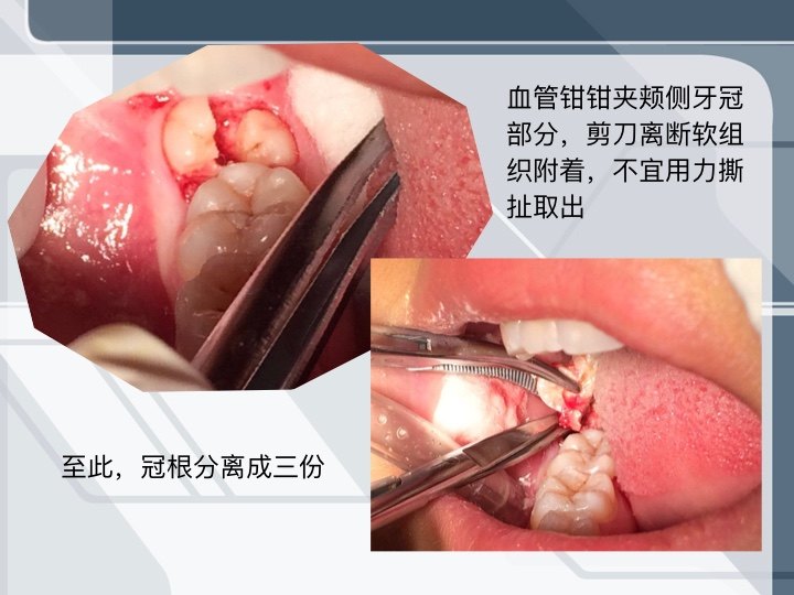最新拔牙技术,轻松解决牙齿烦恼