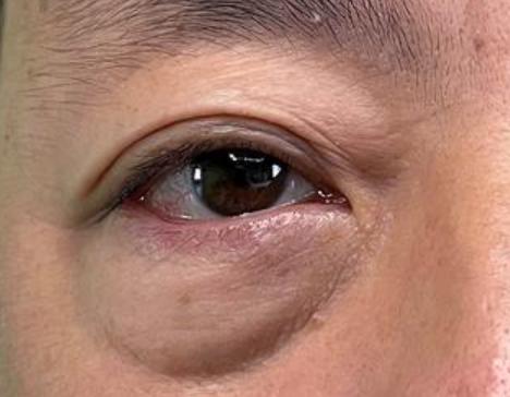 探秘小巷美容秘密,最新去眼袋最佳方法全解析