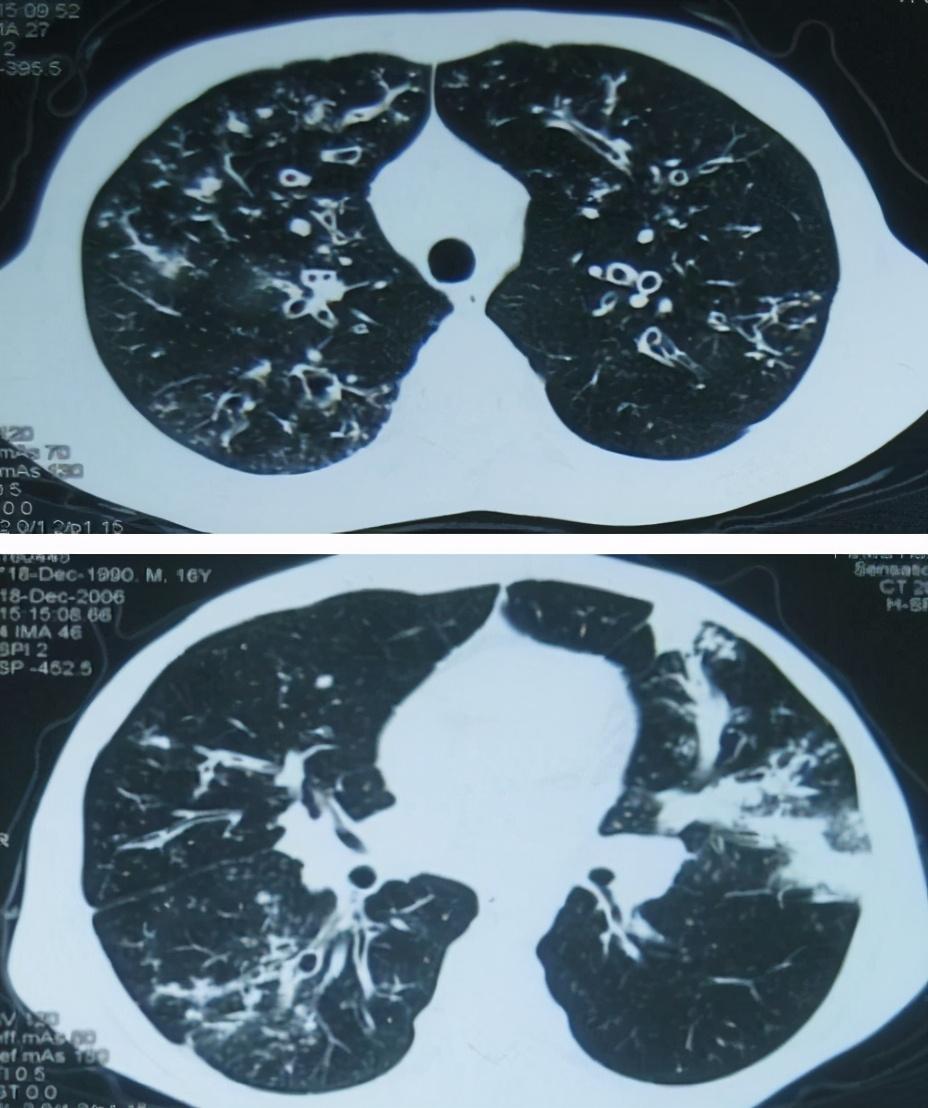 支气管扩张症最新研究,步骤指南与最新进展探索