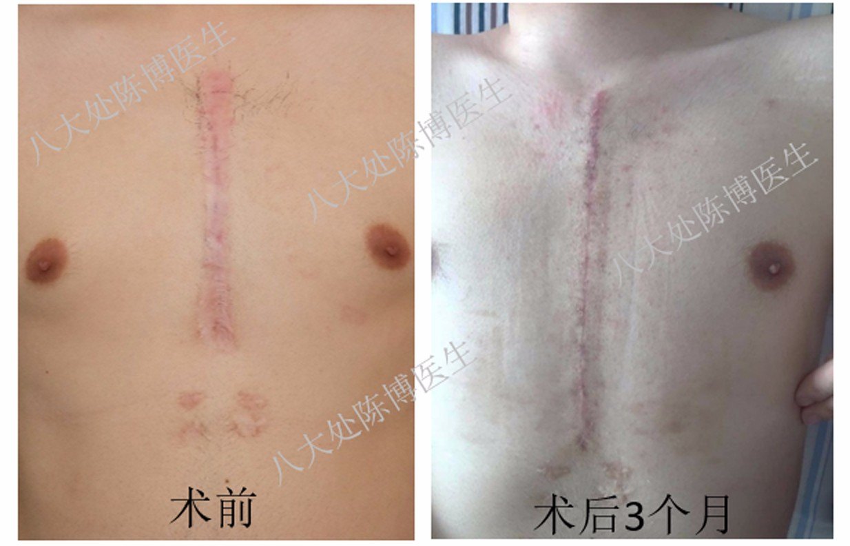 最新瘢痕治疗技术,小疤痕的奇遇与友情的治愈力量