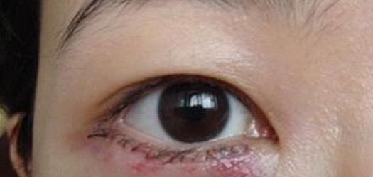 最新眼袋手术视频,变化的力量,自信与成就感的诞生之路