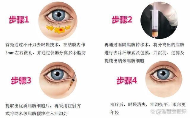 最新眼袋手术视频,变化的力量,自信与成就感的诞生之路